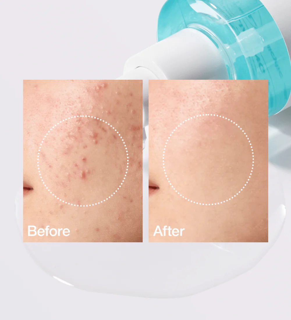 Anua BHA 2% Gentle Exfoliating Toner 150ML